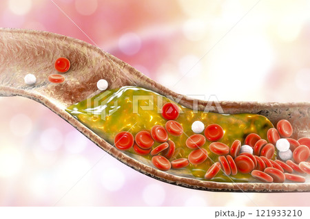 Cholesterol plaque in artery 121933210