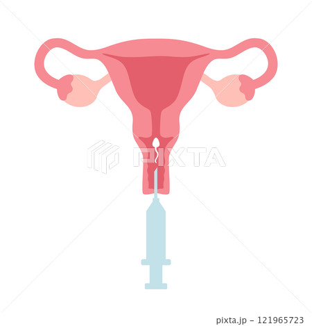 Intrauterine insemination infographic. IUI. Uterus and syringe with sperm illustration in cartoon flat style. Vector illustration 121965723