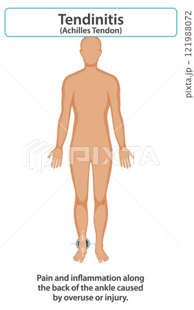 Achilles Tendonitis Illustration and Symptoms 121988072