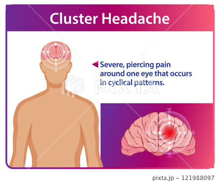Understanding Cluster Headaches and Symptoms Understanding Cluster Headaches and Symptoms 121988097