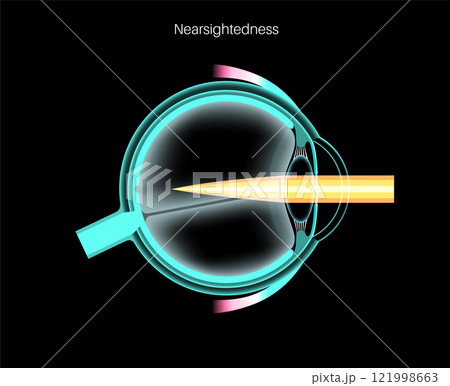 Nearsightedness eye disease 121998663