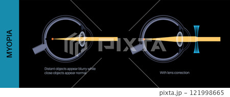 Myopia lens correction Myopia lens correction 121998665