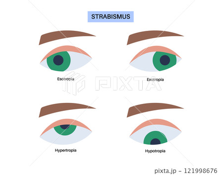 Strabismus eye disease 121998676