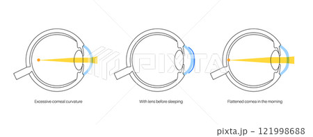 Orthokeratology contact lens 121998688