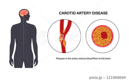 Carotid artery disease 121998694