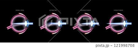 Refractive errors poster Refractive errors poster 121998708