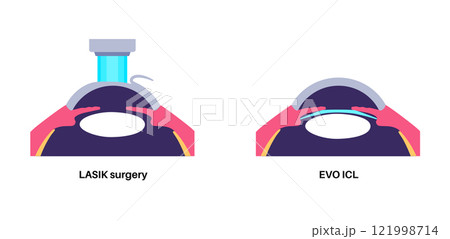 LASIK and ICL EVO 121998714