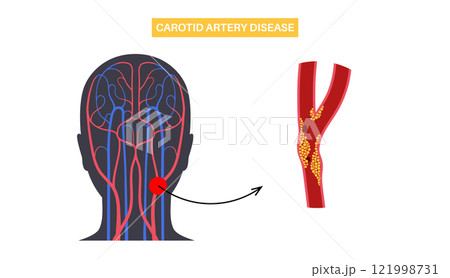 Carotid artery disease 121998731