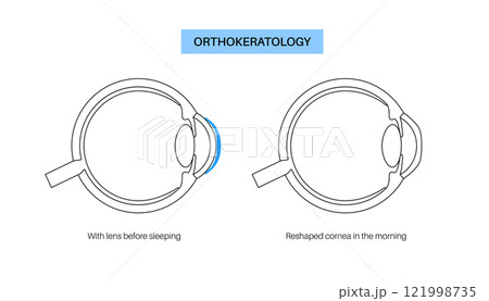 Orthokeratology contact lens 121998735