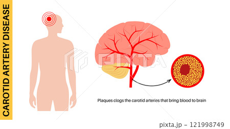 Carotid artery disease Carotid artery disease 121998749