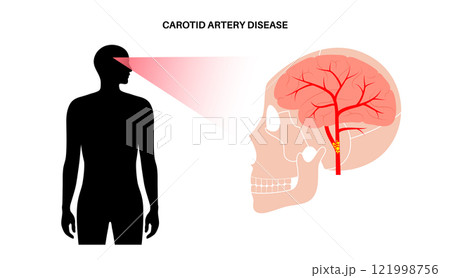 Carotid artery disease Carotid artery disease 121998756