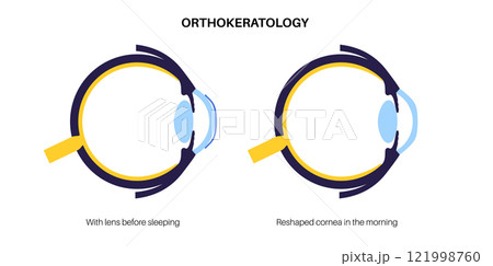 Orthokeratology contact lens 121998760