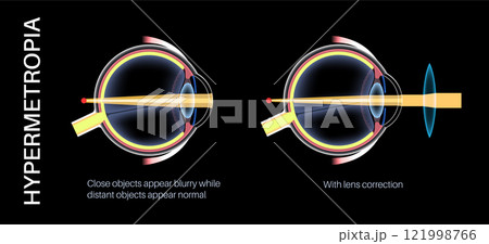 Farsightedness lens correction 121998766