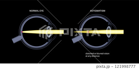 Astigmatism eye disease Astigmatism eye disease 121998777