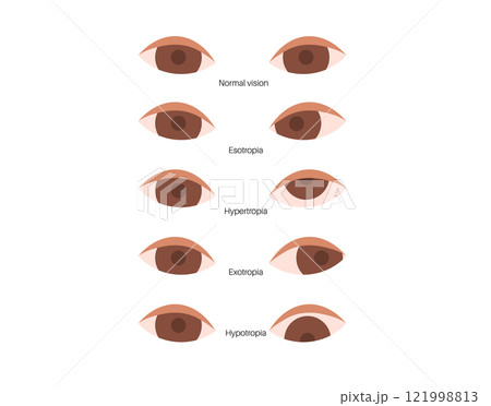 Strabismus eye disease 121998813