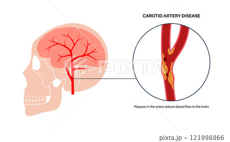 Carotid artery disease 121998866
