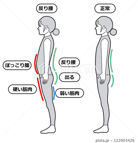 反り腰の状態 反り腰の状態 122003426