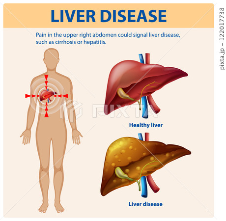 Understanding Liver Disease and Symptoms 122017738