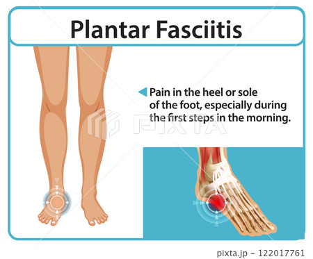 Understanding Plantar Fasciitis Pain Relief Understanding Plantar Fasciitis Pain Relief 122017761