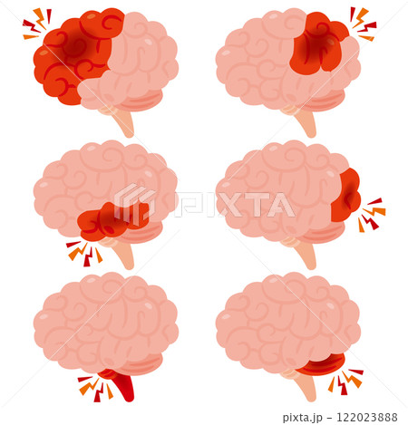 脳出血が起きた脳のイラスト 横視点 脳出血が起きた脳のイラスト 横視点 122023888