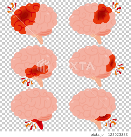 腦出血大腦的插圖，側視圖 122023888