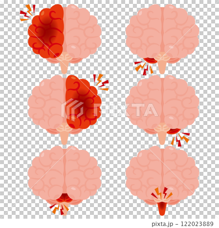 腦出血大腦插圖，前視圖 122023889