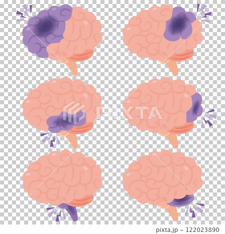 Illustration of a brain with cerebral infarction (side view) 122023890