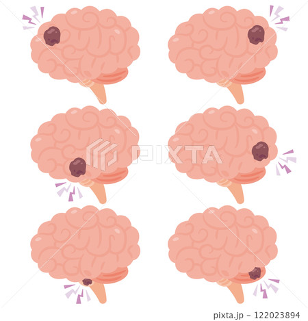 腫瘍がある脳のイラスト　横視点 122023894