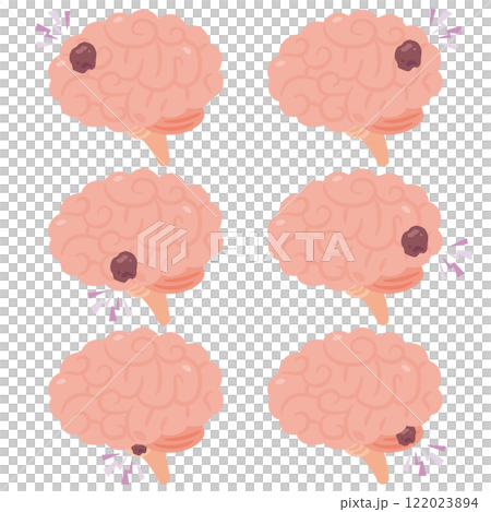 大腦有腫瘤的插圖,側面視圖 大腦有腫瘤的插圖,側面視圖 122023894