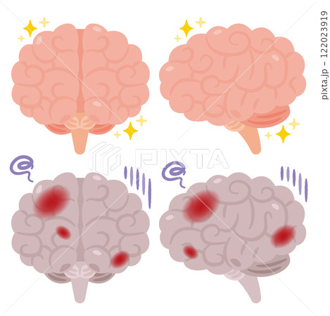 健康でキレイな脳と炎症が起きた不健康な脳のイラスト 122023919
