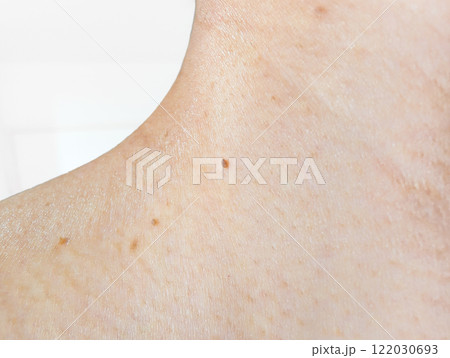 首の付け根のイボ 122030693