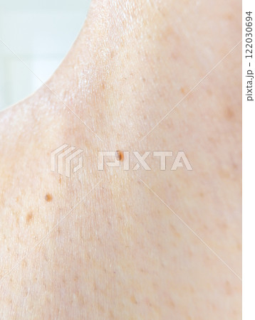 首の付け根のイボ 首の付け根のイボ 122030694