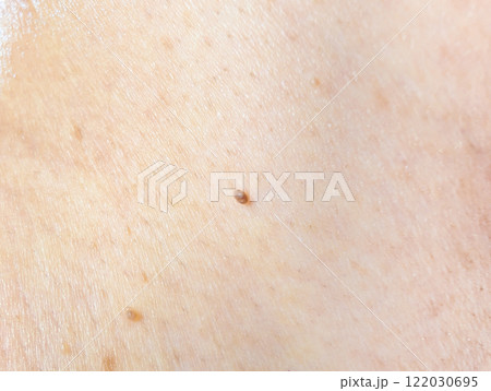 首の付け根のイボ 首の付け根のイボ 122030695