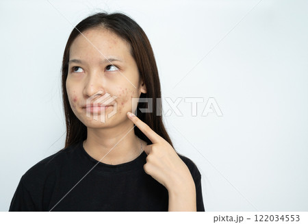 Boring Asian woman pointing to acne problems on her face. Inflamed acne consists of swelling, redness, and pores that are deeply clogged with bacteria, oil, and dead skin cells. Boring Asian woman pointing to acne problems on her face. Inflamed acne consists of swelling, redness, and pores that are deeply clogged with bacteria, oil, and dead skin cells. 122034553