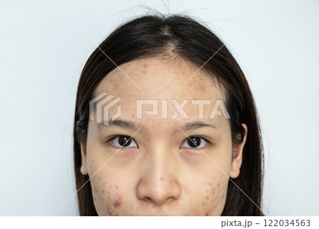 Cropped shot view of Asian woman face with acne inflamed on her face. Cropped shot view of Asian woman face with acne inflamed on her face. 122034563