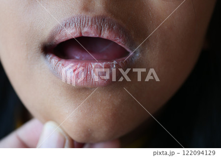 close up of dry lip of a child close up of dry lip of a child 122094129