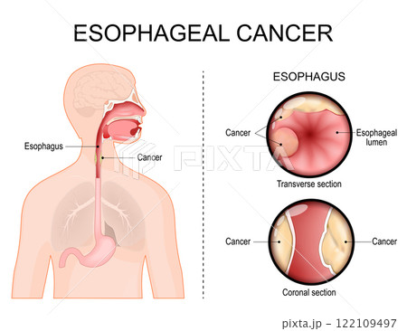 Esophageal cancer. Adenocarcinoma Esophageal cancer. Adenocarcinoma 122109497