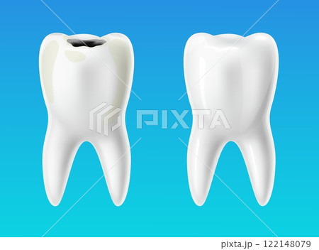Healthy tooth and decayed tooth. 3D isolated teeth, caries professional treatment in stomatology, oral hygiene poster, before and after banner, dentistry advertising vector medical concept 122148079