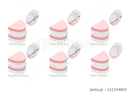 3D Isometric Flat  Illustration of Dental Teeth Braces Types, Orthodontic Options for Teeth Straightening 122154603