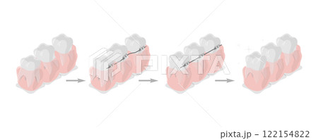 3D Isometric Flat  Illustration of Dental Teeth Braces, Orthodontic Care 122154822