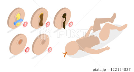 3D Isometric Flat  Illustration of Umbilical Cord, After Birth Stages. Swollen, Dry Pus, Scar Tissue, Fall Off 122154827