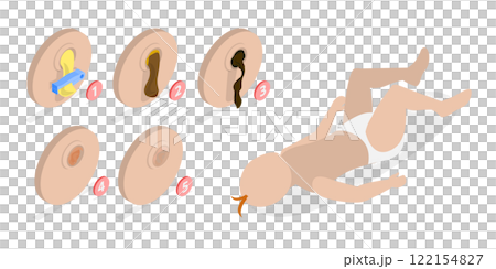 3D Isometric Flat  Illustration of Umbilical Cord, After Birth Stages. Swollen, Dry Pus, Scar Tissue, Fall Off 122154827