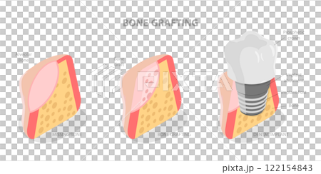 3D Isometric Flat Illustration of Bone Grafting, Understanding of Teeth Structure for Successful Treatment 3D Isometric Flat Illustration of Bone Grafting, Understanding of Teeth Structure for Successful Treatment 122154843