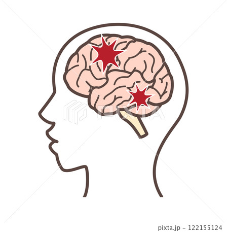 ダメージを受けた脳のイラスト ダメージを受けた脳のイラスト 122155124
