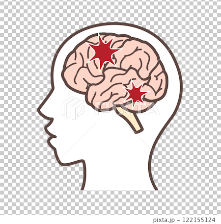 Illustration of a damaged brain Illustration of a damaged brain 122155124