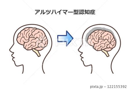 脳のイラスト　アルツハイマー　認知症 122155392
