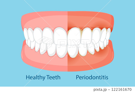 Comparison of Healthy Teeth and Periodontitis Comparison of Healthy Teeth and Periodontitis 122161670