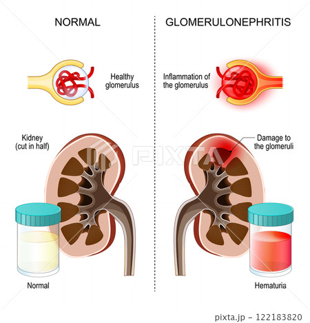 Glomerulonephritis. Kidney inflammation. Glomerulonephritis. Kidney inflammation. 122183820