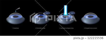 LASIK eye surgery LASIK eye surgery 122215536