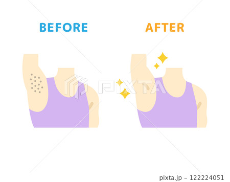 ワキ脱毛の、ビフォーアフターのアイコンのイラスト 122224051